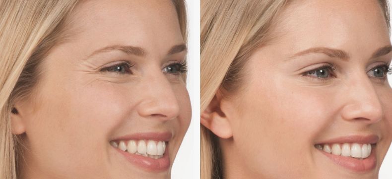 Before &After